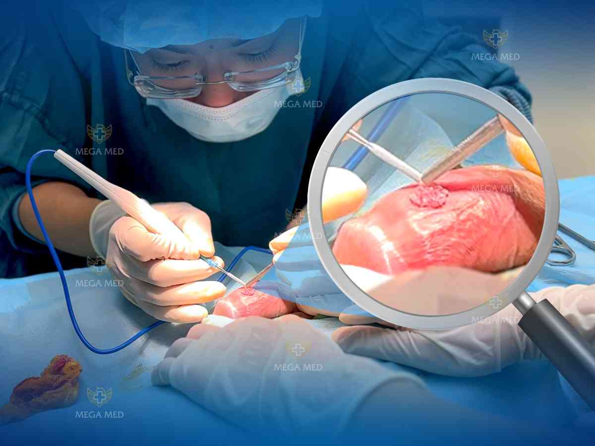 Cắt đốt sùi mào gà